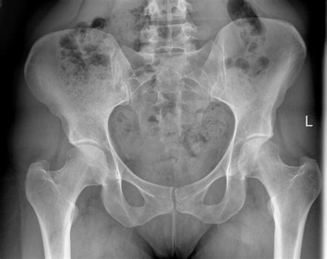 Normal Pelvis And Both Hips Image