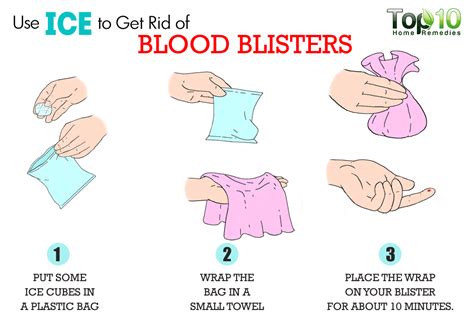 How To Get Rid Of Blood Blisters Top 10 Home Remedies