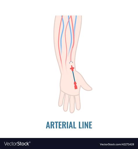 Arterial Line Catheter Placed In The Radial Artery