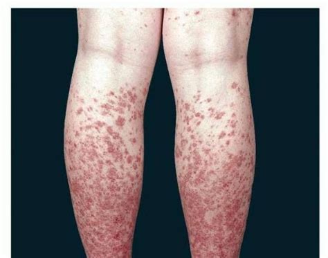 Idiopathic Thrombocytopenic Purpura Itp Is A Blood Disorder For Which