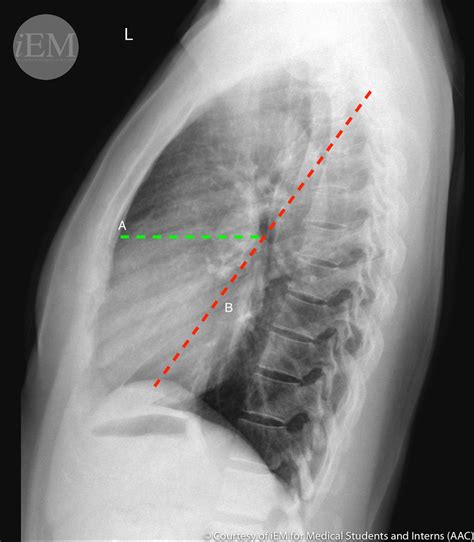 Chest Radiograph Anatomy