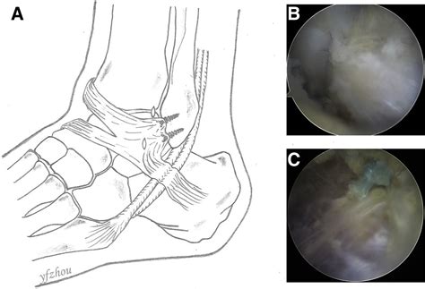 All Inside Arthroscopic Modified Broström Technique To Repair Anterior