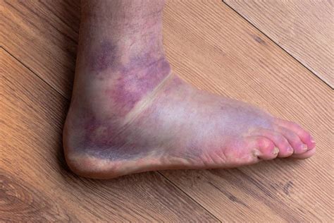 Swollen Ankles Stock Photos Pictures And Royalty Free Images Istock