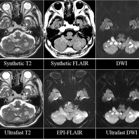 Acute Infarction In The Bilateral Cerebellar Hemispheres In An