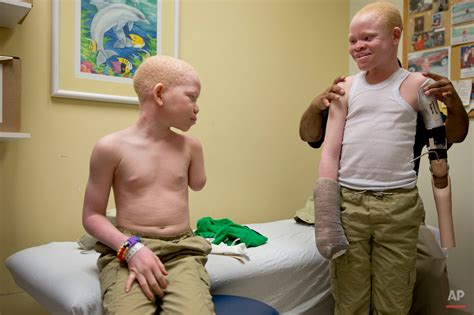For Africas Hunted Children With Albinism New Limbs And New Hope — Ap