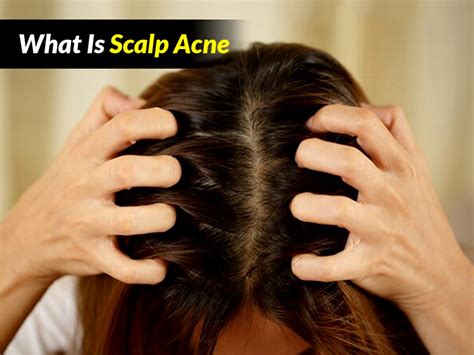 Is It Scalp Acne Symptoms Treatment Prevention Tips