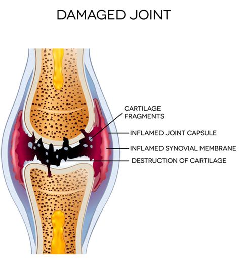 Albuquerque Joint Pain Clinic Knee And Shoulder Treatment Dr Raiten