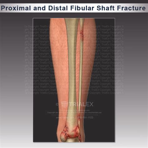 Proximal And Distal Fibular Shaft Fracture Trialexhibits Inc