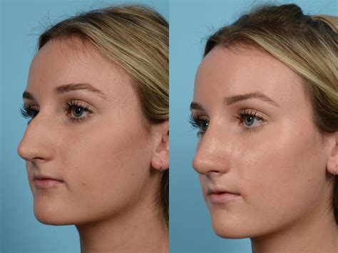 Rhinoplasty By Dr Mustoe Before And After Pictures Case Chicago