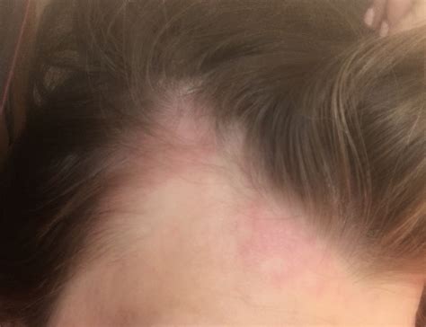 Аллергия на краску для волос Вопрос дерматологу 03 Онлайн