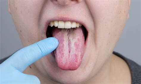White Spots On Tongue Covid Or The Vaccine Among Causes Says Expert