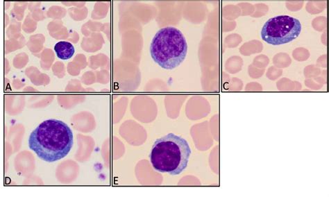 Cureus Morphologic Changes In Circulating Blood Cells Of Covid 19