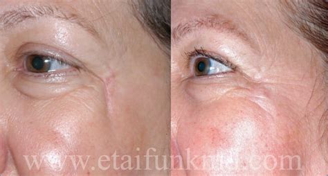 Facial Scar Revision Funk Facial Plastic Surgery