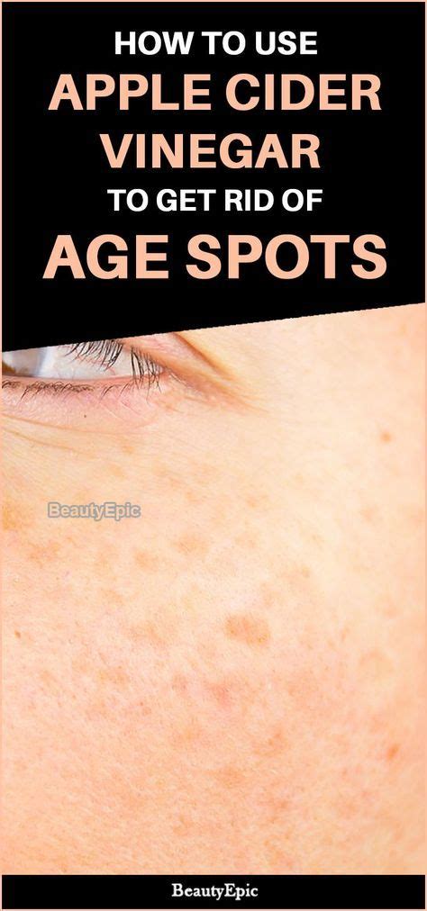 How To Treat Age Spots With Apple Cider Vinegar Age Spots On Face