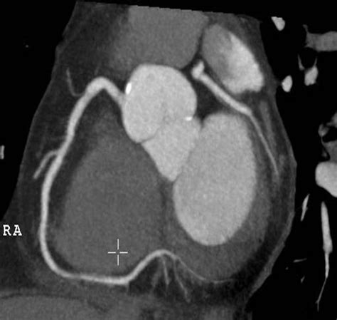 Eine herzmuskelentzündung beginnt oft schleichend und unauffällig: Kardiologie - Röntgen-Thorax, Thorax-CT, Kardio-CT, Kardio-MR