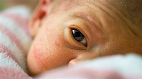 Skin Problems In The Premature Baby Healthline