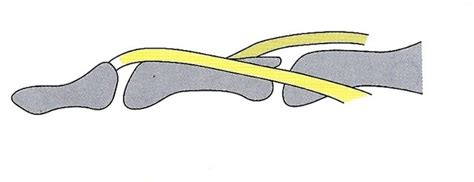 つき指（マレット変形・槌指） - 久美接骨院（名古屋市中村区）