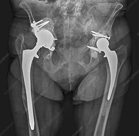 Double Hip Replacement X Ray Stock Image C0337361 Science Photo