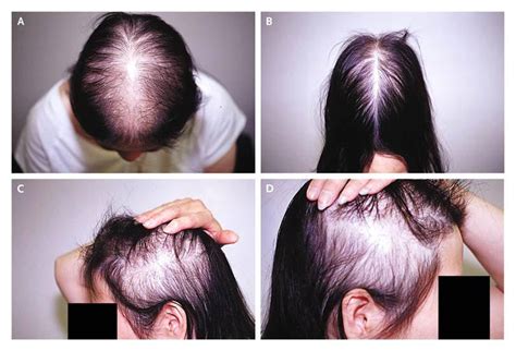 Top Image Covid Hair Loss Female Thptnganamst Edu Vn