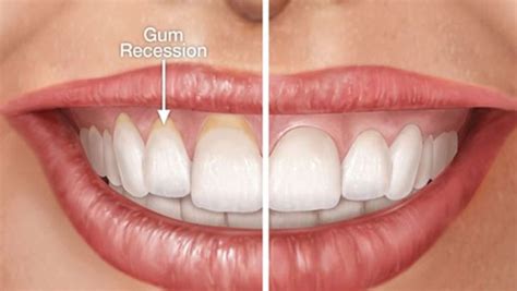 Expert Article Receded Gums Its Causes Symptoms Diagnosis And