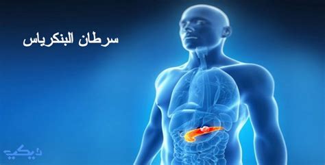 أعراض سرطان البنكرياس وأسباب الإصابة به ويكي مصر