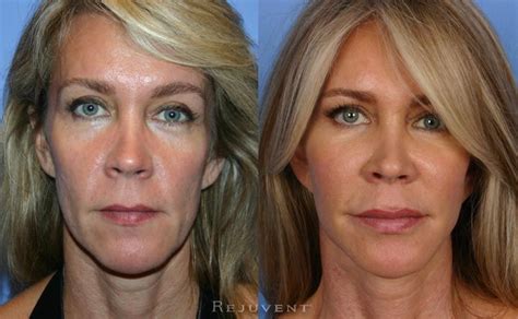 Cheek Enhancement Photos • Rejuvent Medical Spa Scottsdale Cheek Fillers Liquid Facelift