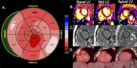 Multimodality Imaging For The Diagnosis Of Infiltrative