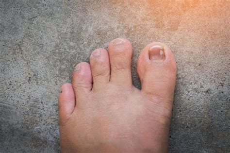 Toenail Discoloration Causes Prevention And Treatments
