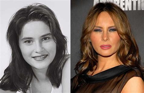 Melania Trump Says Shes Had Zero Plastic Surgery And Is Against Botox