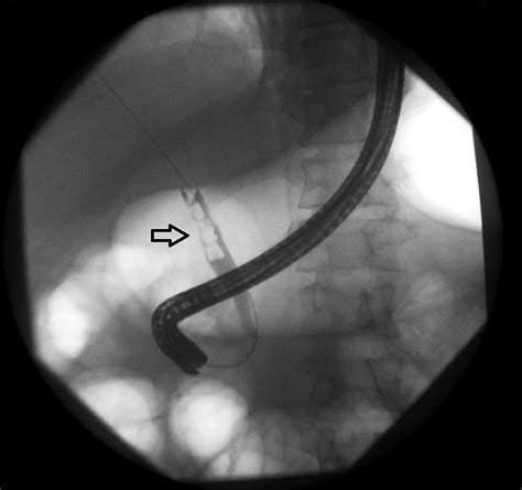 Pulseless Electrical Activity Arrest Due To Air Embolism During