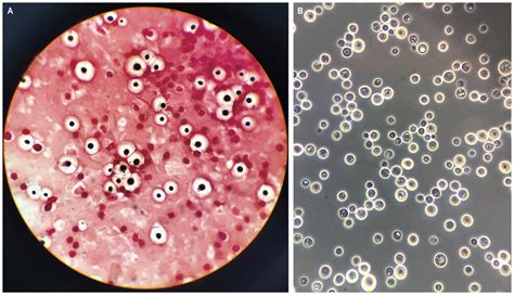 Cryptococcus Neoformans Ecured