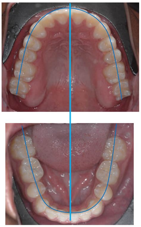 Camuflaje Clase Iii Con Expansión Maxilar Y Extracciones De Primeros