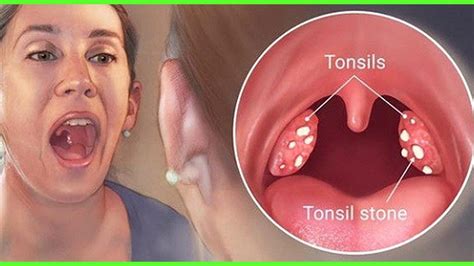 Tonsillitis Diagram