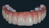 Images of Zirconium Dental Implants Side Effects