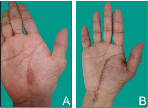 A Preoperative Photograph Of Right Hand A Thick Scar On Previous