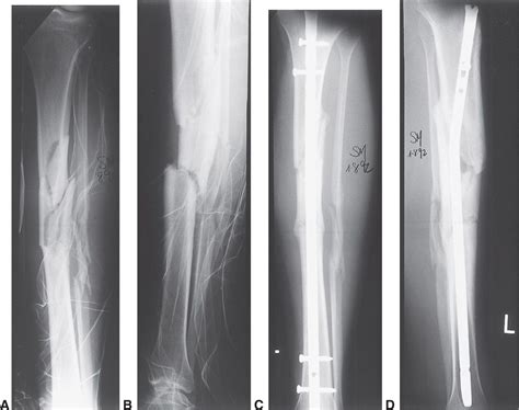 Fractures Of The Tibia Musculoskeletal Key