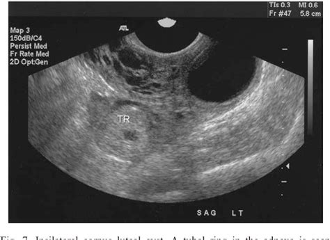 Figure 10 From Ectopic Pregnancy A Pictorial Review Semantic Scholar