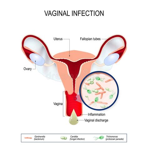Vaginal Infection And Causative Agents Of Vulvovaginitis Stock Vector