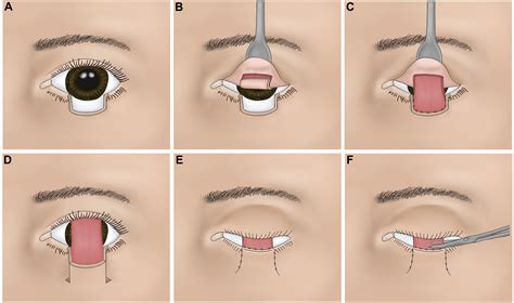 Eyelid Defect Reconstruction