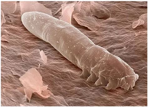 The Tiny Mites That Live In Our Skin Imedicalaesthetics