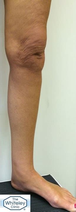 Hidden Varicose Veins With Swollen Leg Not Lymphoedema