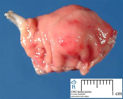 digestive pancreatic heterotopia - Humpath.com - Human pathology