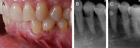 External Cervical Resorption A Review Journal Of Endodontics