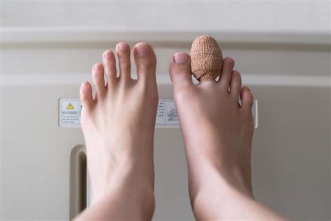 Everything You Need To Know About Second Toe Shortening Surgery