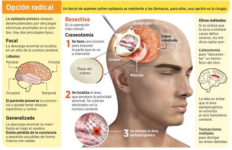 Anatomia Da Epilepsia