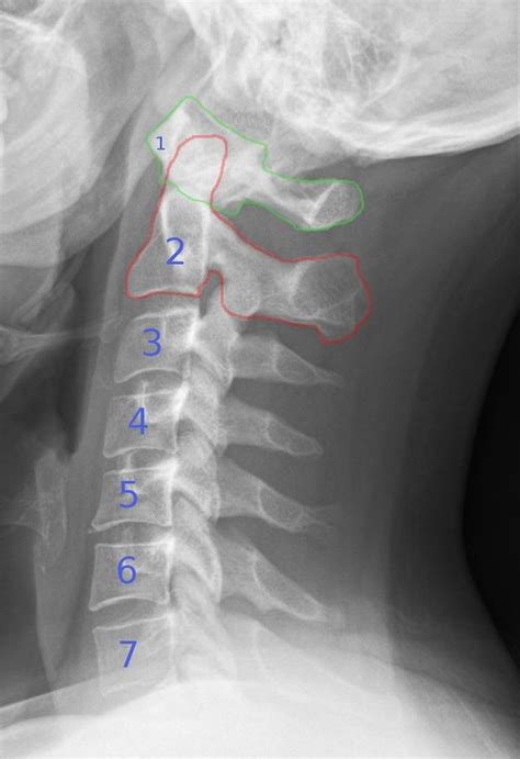 Cervical Spine X Ray Interpretation Wikem