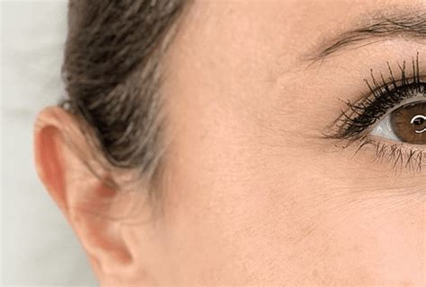 Crows Feet Treatment For Crows Feet Eyes And Wrinkles In Sydney