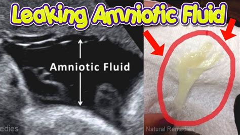 Amniotic Fluid Leak Test At Home Ideas