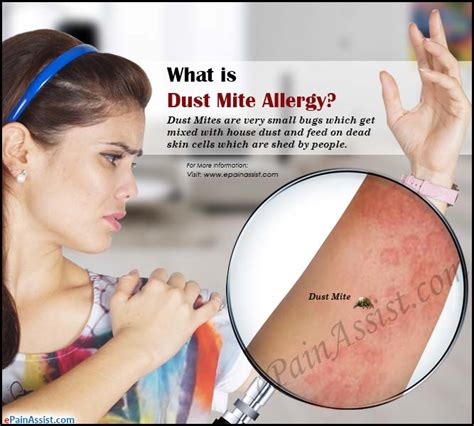 What Is Dust Mite Allergycausessymptomstreatmentprevention