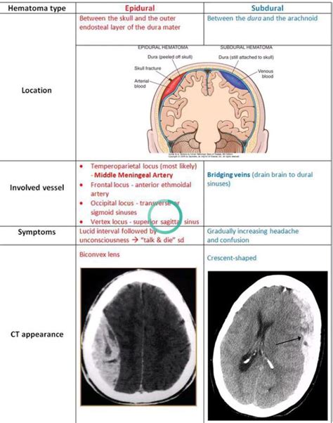 Difference Between Extradural And Subdural Hematoma Medizzy